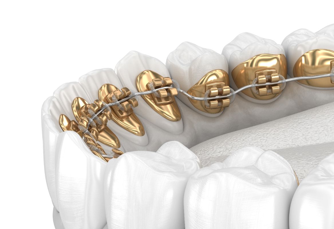 Everything You Need To Know About Lingual Braces