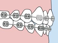 loose bracket or braces band graphic